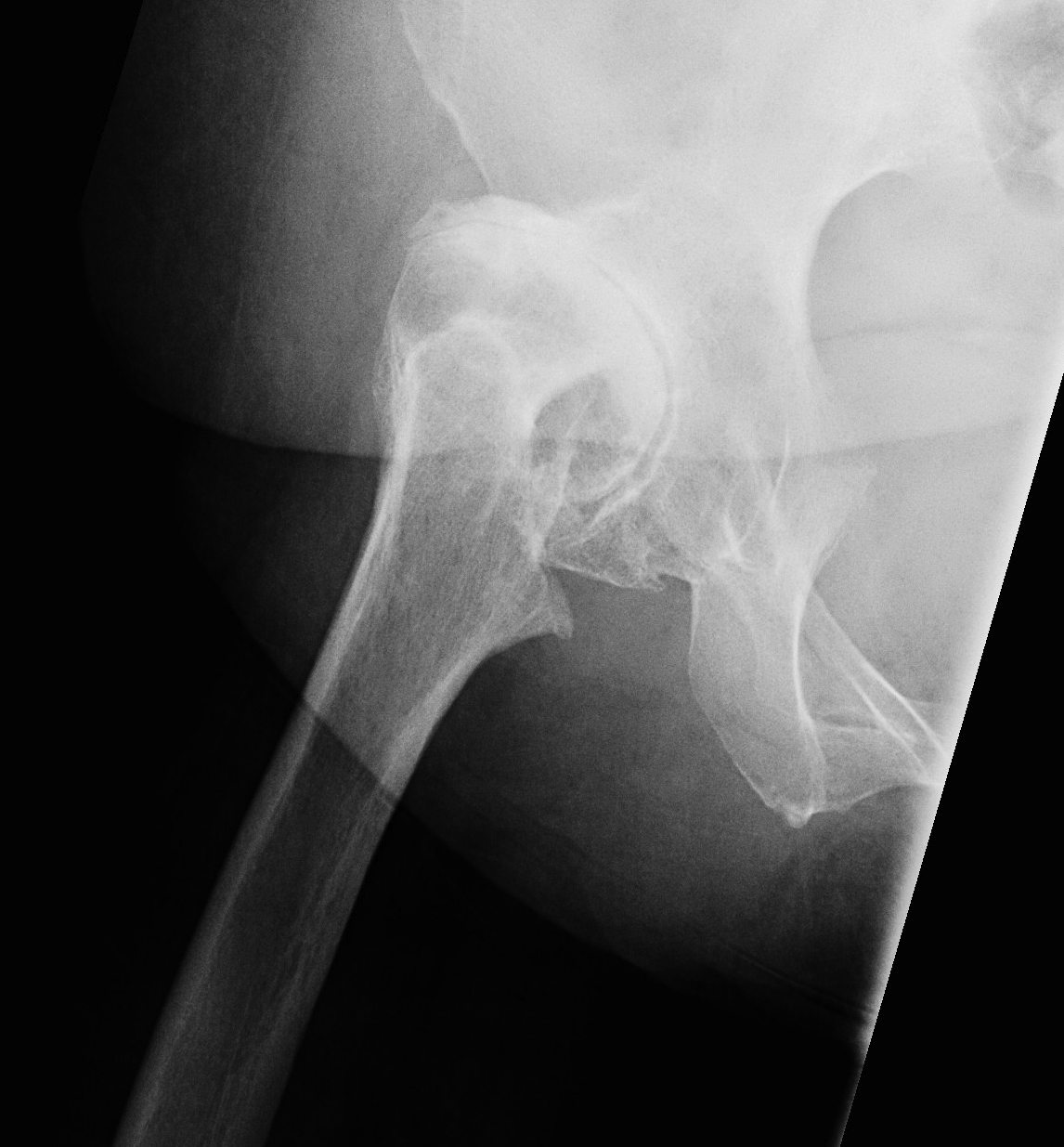 DDH Anterior Acetabular Insufficiency